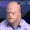 В мире всего 16 таких людей: 18-летний Алексей с внешностью гуманоида живет в приемной семье